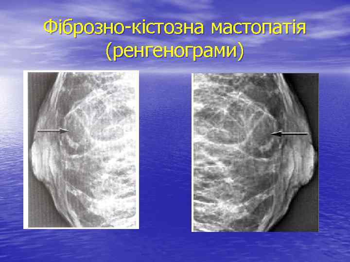 Фіброзно-кістозна мастопатія (ренгенограми) 