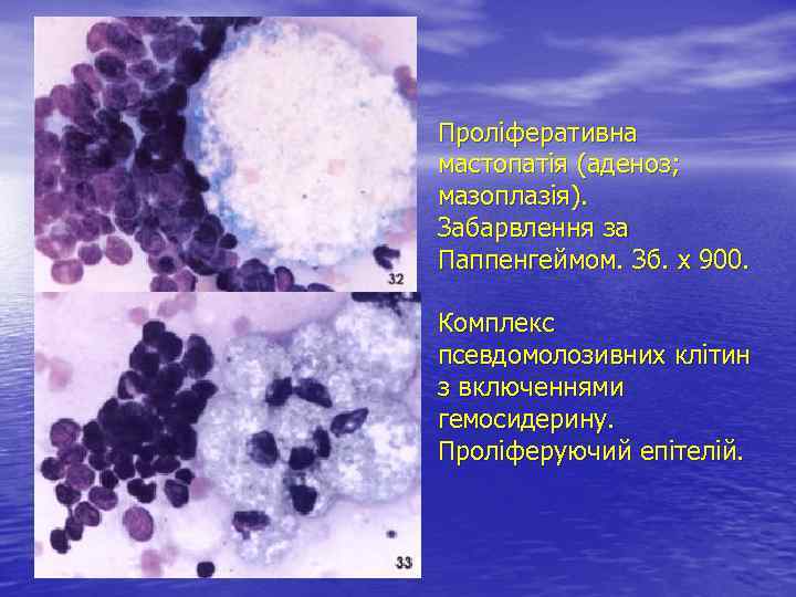 Проліферативна мастопатія (аденоз; мазоплазія). Забарвлення за Паппенгеймом. Зб. х 900. Комплекс псевдомолозивних клітин з