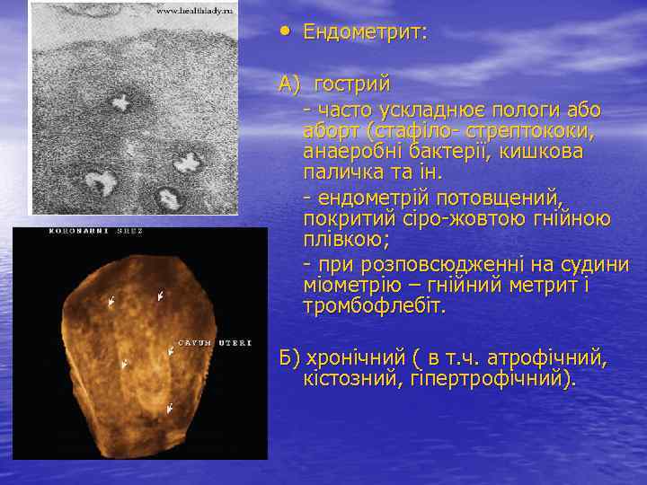  • Ендометрит: А) гострий - часто ускладнює пологи аборт (стафіло- стрептококи, анаеробні бактерії,
