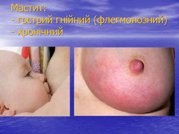Мастит: - гострий гнійний (флегмонозний) - хронічний 