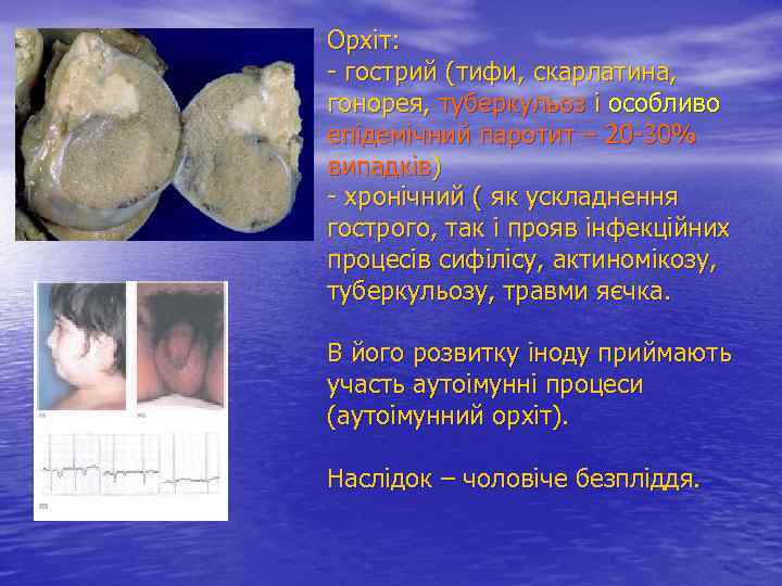 Орхіт: - гострий (тифи, скарлатина, гонорея, туберкульоз і особливо епідемічний паротит – 20 -30%