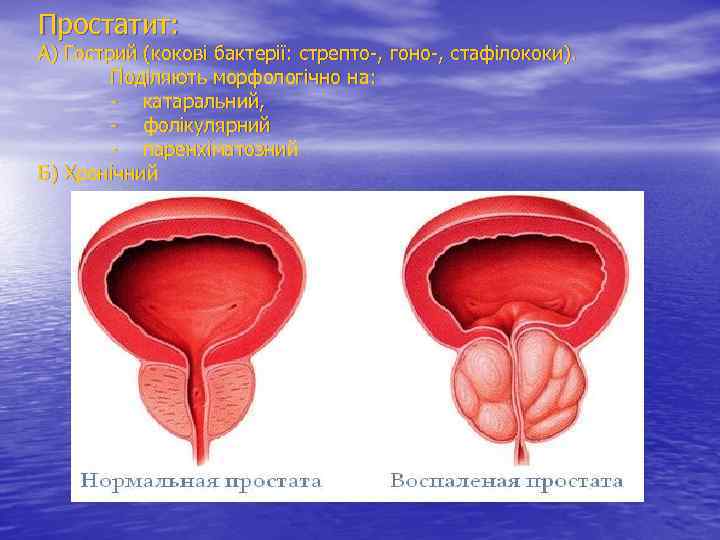 Простатит: А) Гострий (кокові бактерії: стрепто-, гоно-, стафілококи). Поділяють морфологічно на: - катаральний, -