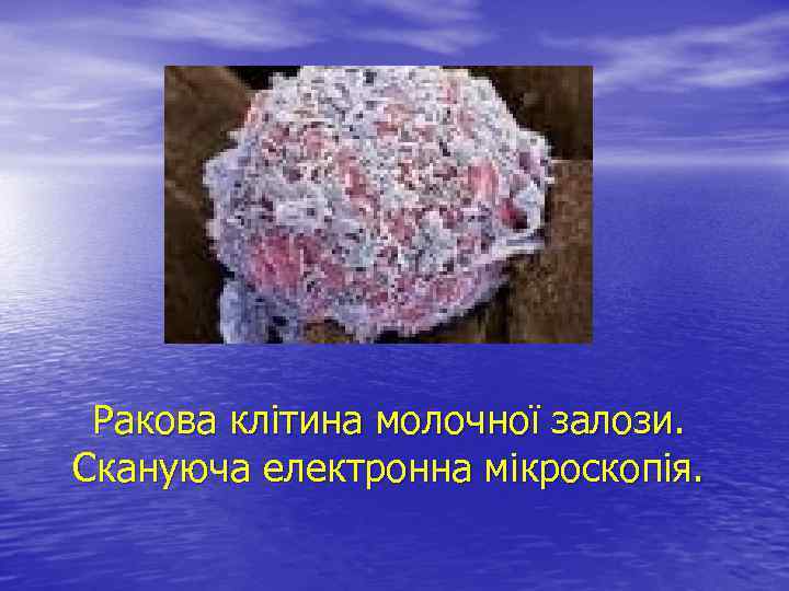 Ракова клітина молочної залози. Скануюча електронна мікроскопія. 