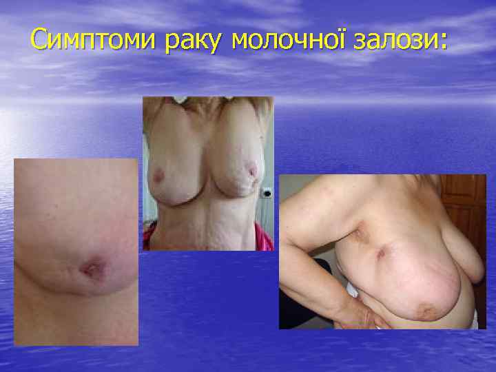 Симптоми раку молочної залози: 