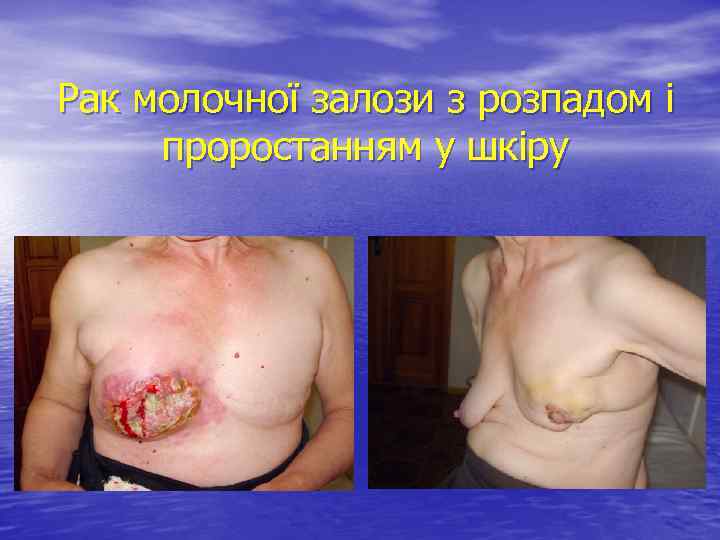 Рак молочної залози з розпадом і проростанням у шкіру 