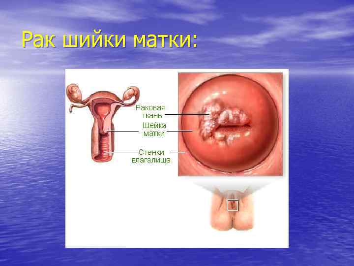 Рак шийки матки: 