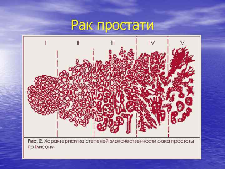 Рак простати 