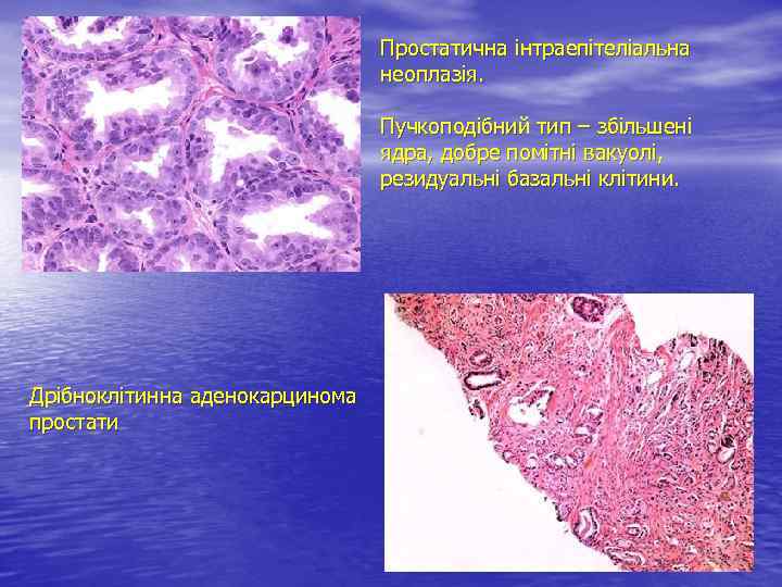 Простатична інтраепітеліальна неоплазія. Пучкоподібний тип – збільшені ядра, добре помітні вакуолі, резидуальні базальні клітини.