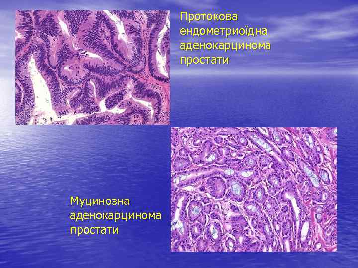 Протокова ендометриоїдна аденокарцинома простати Муцинозна аденокарцинома простати 