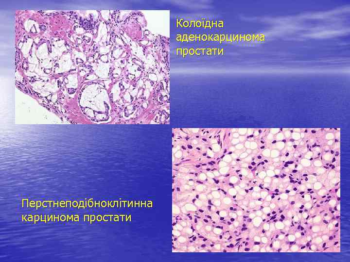 Колоїдна аденокарцинома простати Перстнеподібноклітинна карцинома простати 