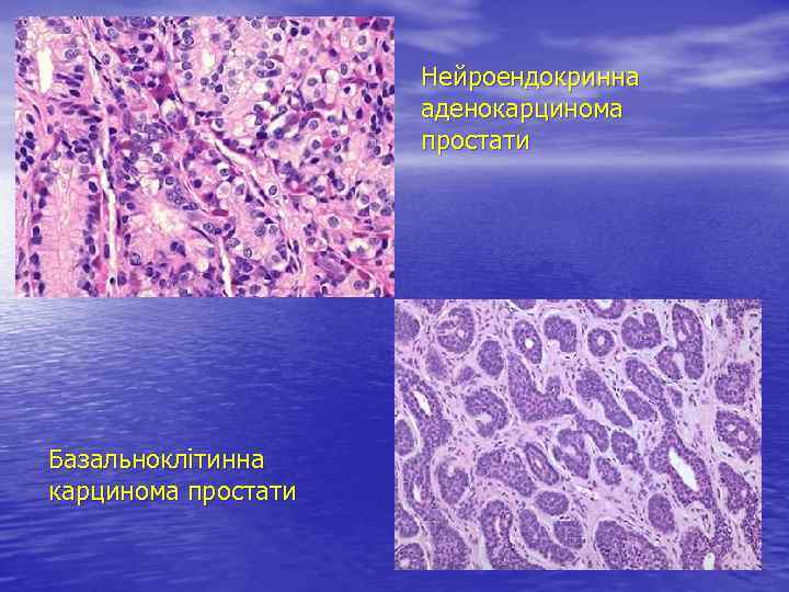 Нейроендокринна аденокарцинома простати Базальноклітинна карцинома простати 