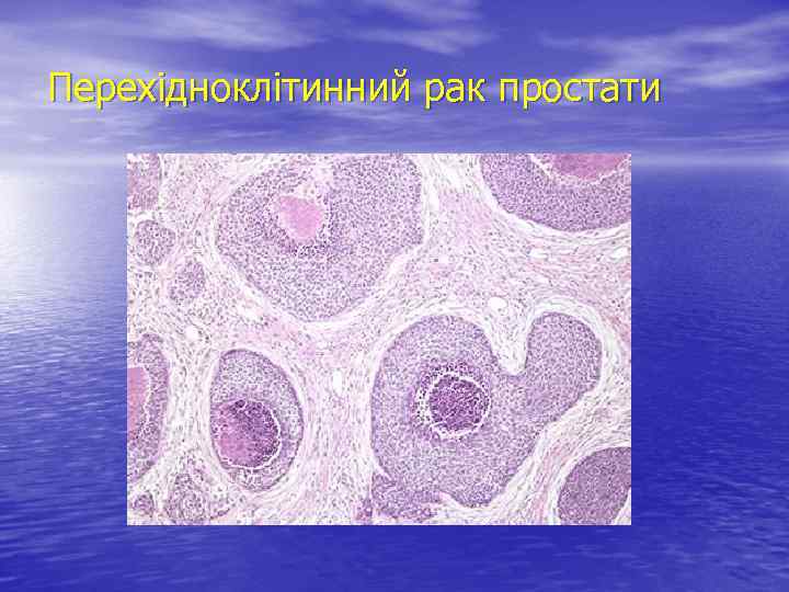 Перехідноклітинний рак простати 