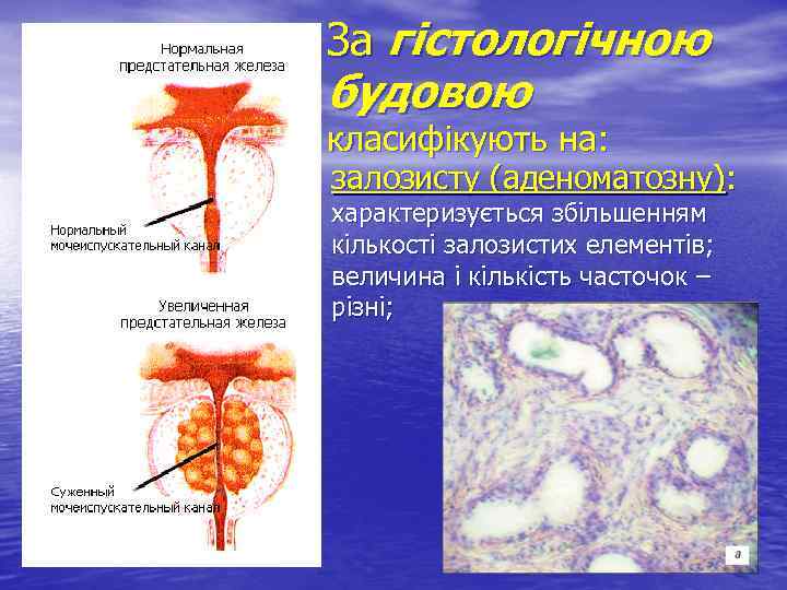 За гістологічною будовою класифікують на: • залозисту (аденоматозну): характеризується збільшенням кількості залозистих елементів; величина
