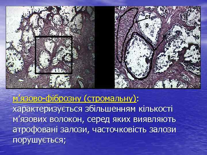 м’язово-фіброзну (стромальну): характеризується збільшенням кількості м’язових волокон, серед яких виявляють атрофовані залози, часточковість залози