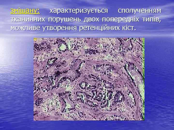 змішану: характеризується сполученням тканинних порушень двох попередніх типів, можливе утворення ретенційних кіст. 