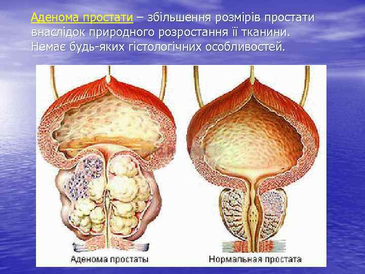Аденома простати – збільшення розмірів простати внаслідок природного розростання її тканини. Немає будь-яких гістологічних