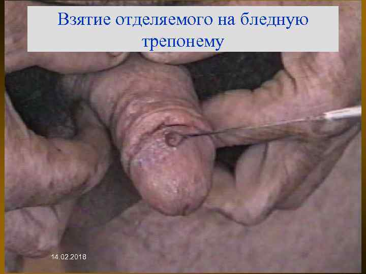 Взятие отделяемого на бледную трепонему 14. 02. 2018 