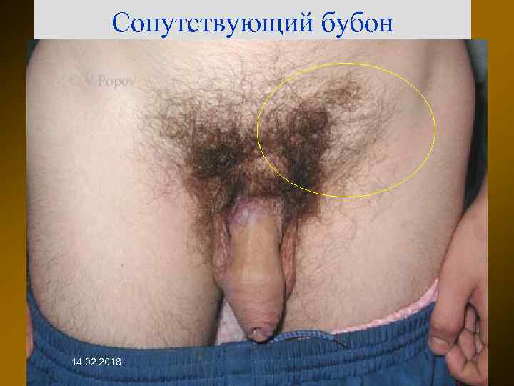 Сопутствующий бубон 14. 02. 2018 