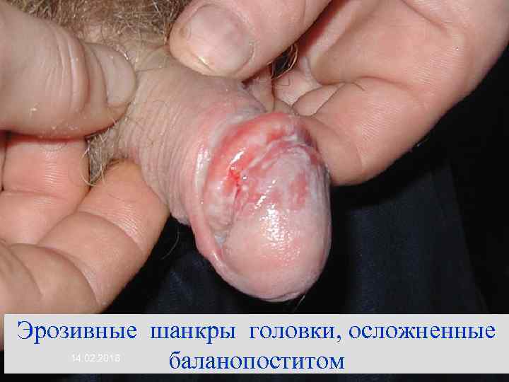 Эрозивные шанкры головки, осложненные баланопоститом 14. 02. 2018 