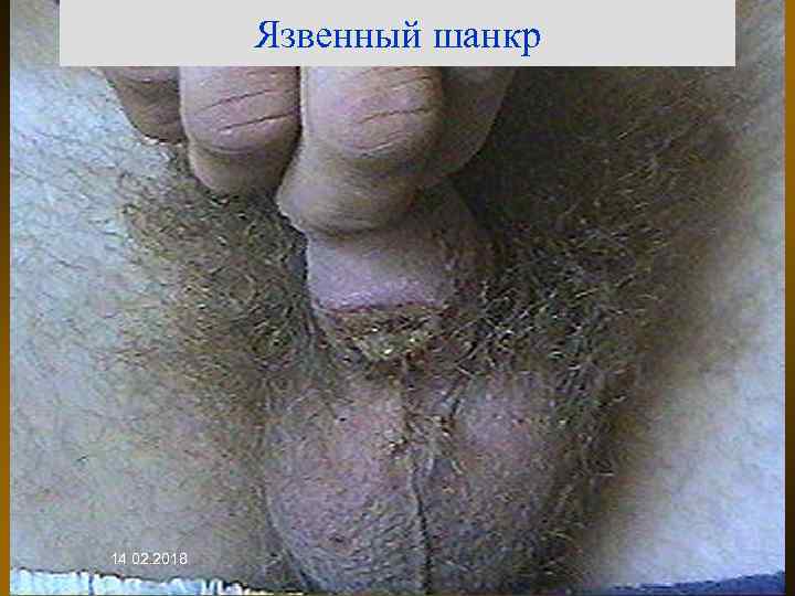 Язвенный шанкр 14. 02. 2018 