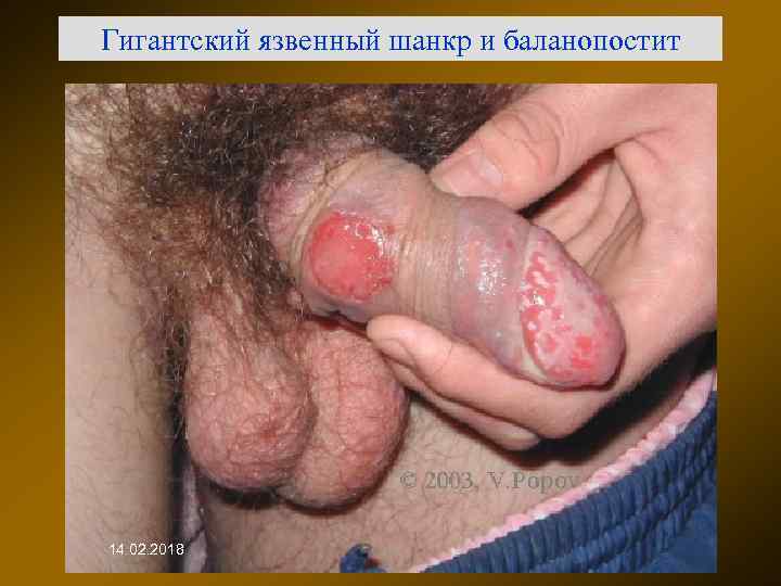 Гигантский язвенный шанкр и баланопостит 14. 02. 2018 