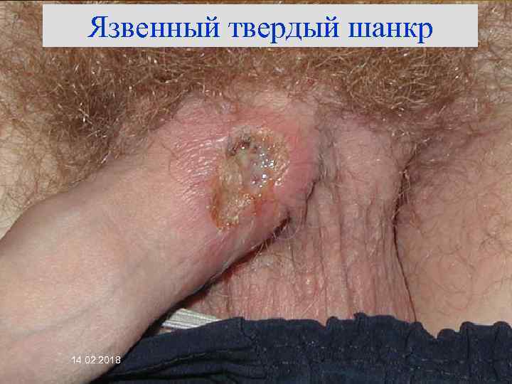 Язвенный твердый шанкр 14. 02. 2018 