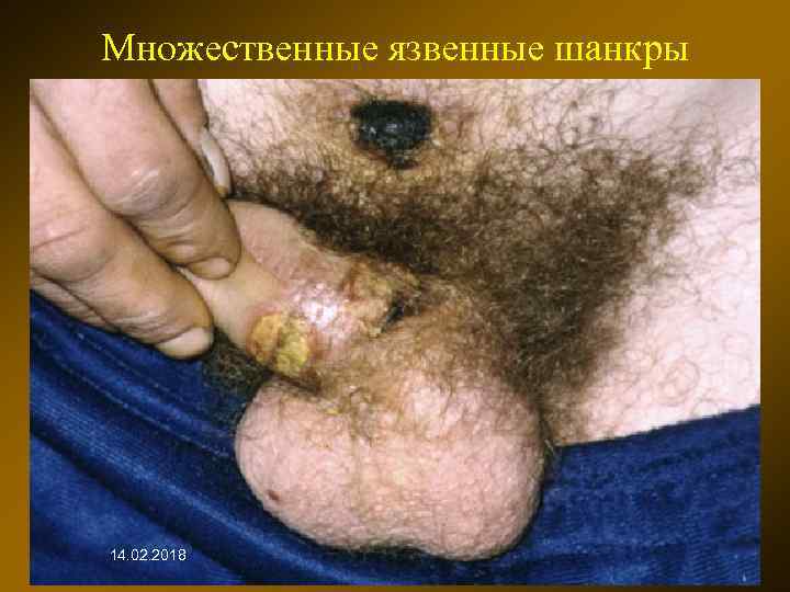 Множественные язвенные шанкры 14. 02. 2018 