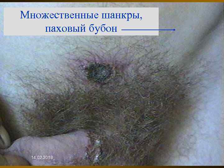 Множественные шанкры, паховый бубон 14. 02. 2018 