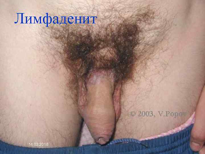 Лимфаденит 14. 02. 2018 