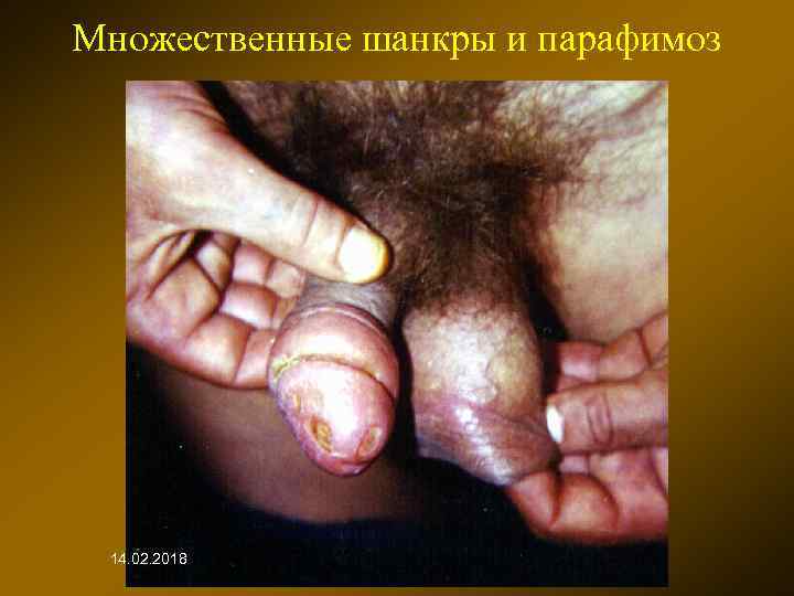 Множественные шанкры и парафимоз 14. 02. 2018 