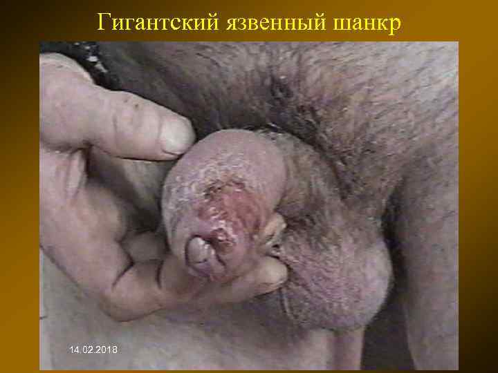 Гигантский язвенный шанкр 14. 02. 2018 