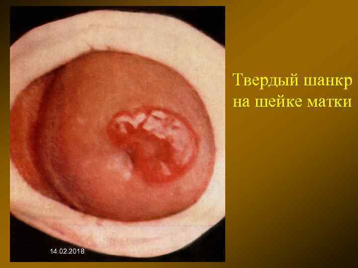 Твердый шанкр на шейке матки 14. 02. 2018 