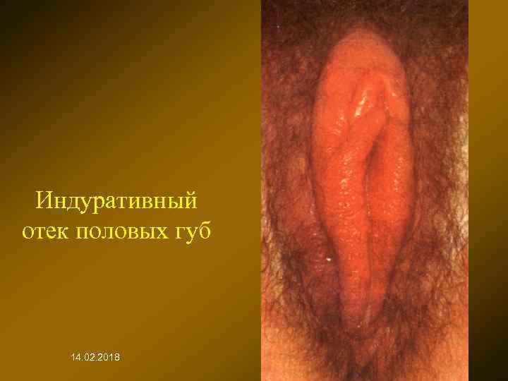Индуративный отек половых губ 14. 02. 2018 