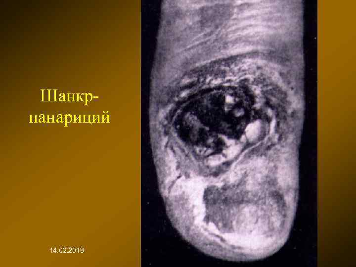 Шанкрпанариций 14. 02. 2018 