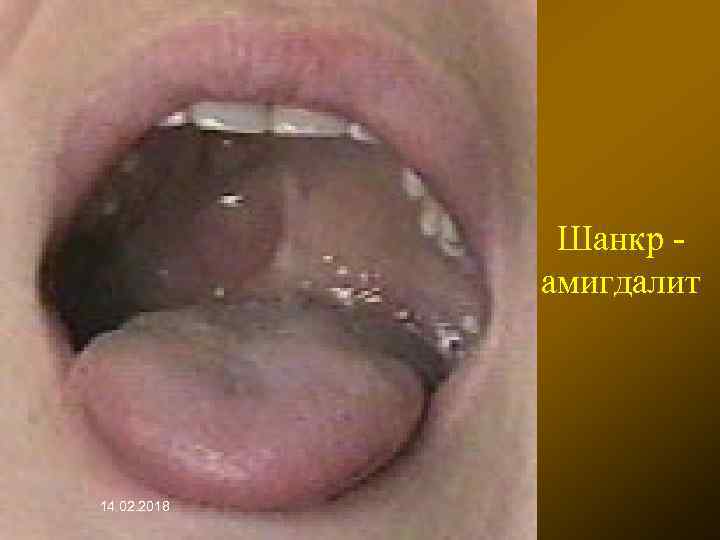 Шанкр амигдалит 14. 02. 2018 