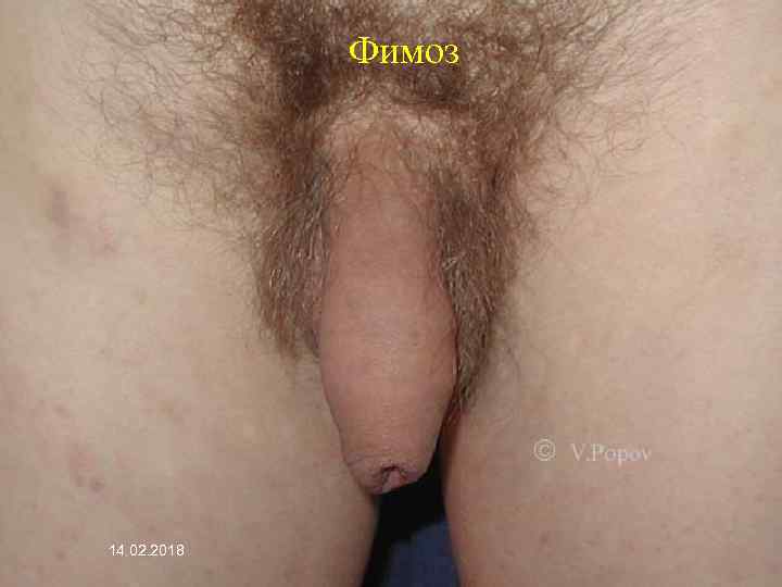 Фимоз 14. 02. 2018 
