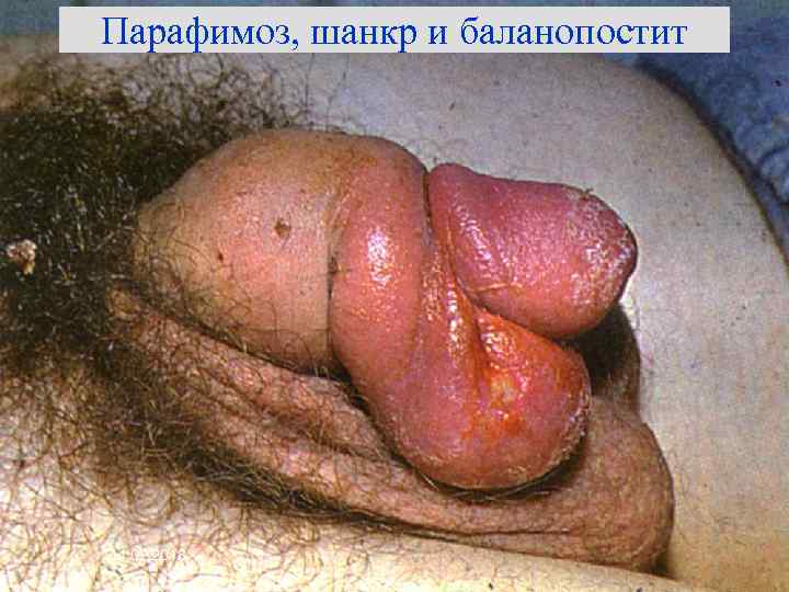 Парафимоз, шанкр и баланопостит 14. 02. 2018 