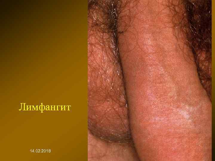 Лимфангит 14. 02. 2018 