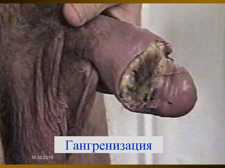 Гангренизация 14. 02. 2018 