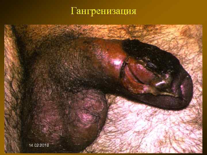 Гангренизация 14. 02. 2018 