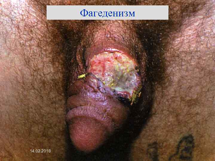 Фагеденизм 14. 02. 2018 