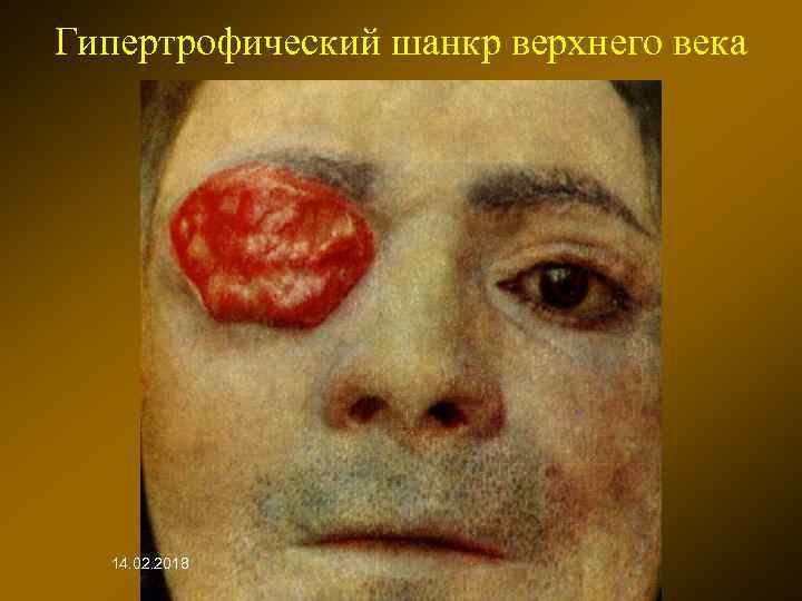 Гипертрофический шанкр верхнего века 14. 02. 2018 