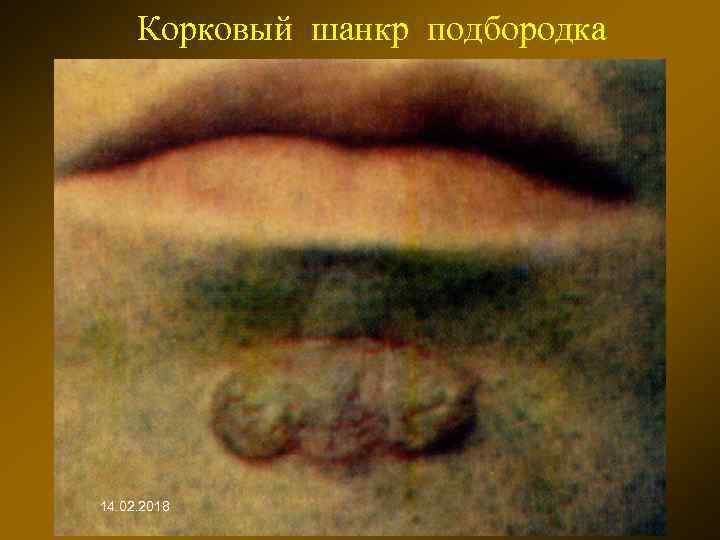 Корковый шанкр подбородка 14. 02. 2018 