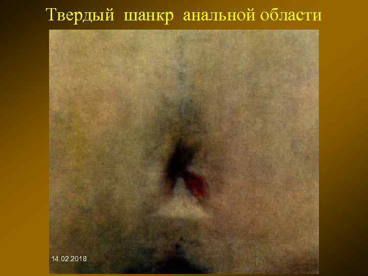 Твердый шанкр анальной области 14. 02. 2018 