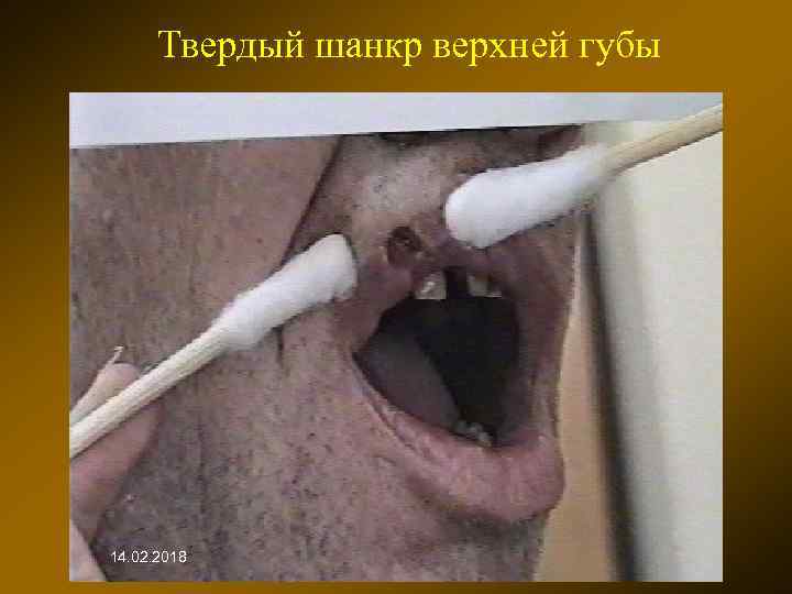 Твердый шанкр верхней губы 14. 02. 2018 