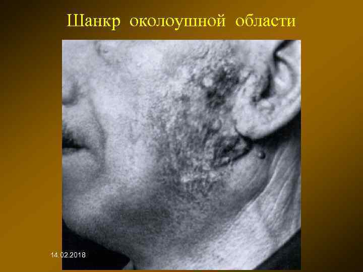 Шанкр околоушной области 14. 02. 2018 
