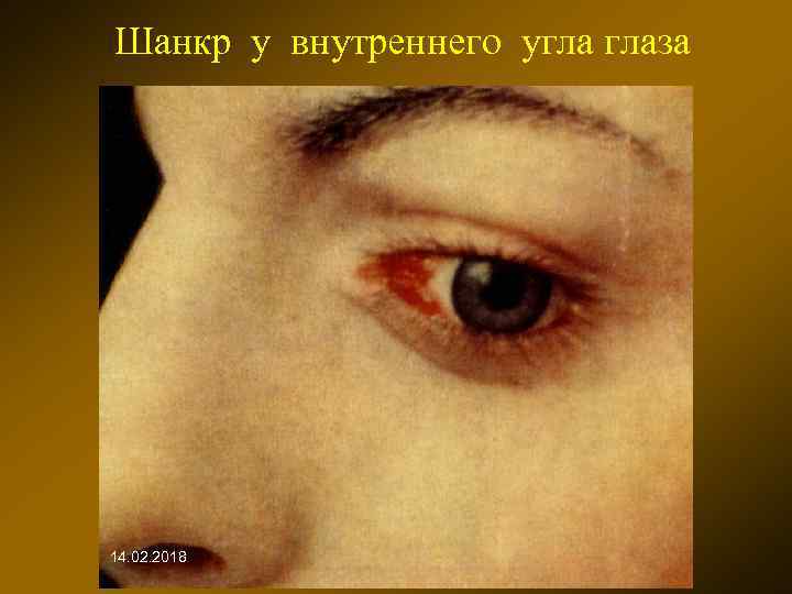 Шанкр у внутреннего угла глаза 14. 02. 2018 
