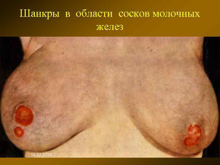 Шанкры в области сосков молочных желез 14. 02. 2018 
