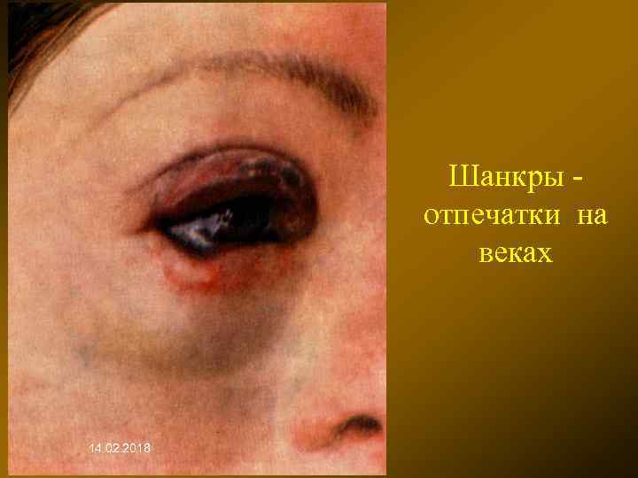 Шанкры отпечатки на веках 14. 02. 2018 