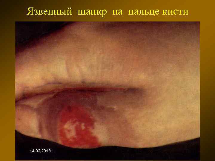 Язвенный шанкр на пальце кисти 14. 02. 2018 